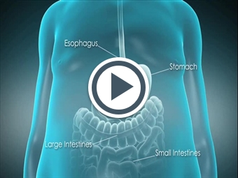 Prosthesis Gastric Sleeve  : This Involves Making Five Or Six Small Incisions In The Abdomen And Performing The Procedure Using A Video Camera (Laparoscope) And Long Instruments.